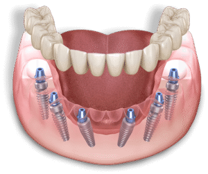 full-arch-dental-implant-model-1