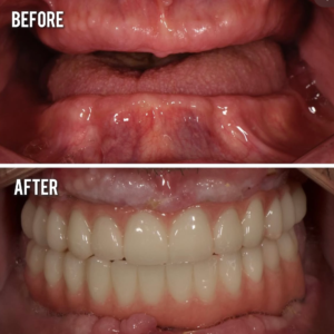 Dentures for 25 years replaced with implant retained prosthetic, 24 hours after implant surgery.