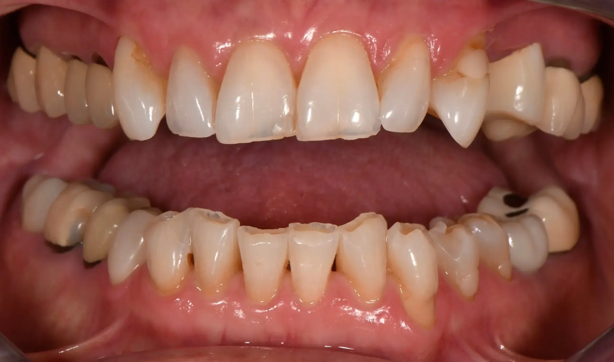 Close-up of worn, chipped front teeth, a failing crown, and old metal fillings before full mouth rehabilitation at Q Dental in Champaign, IL
